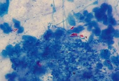 Mycobacterium_tuberculosis_in_Ziehl-Neelsen_stained_smear_of_sputum