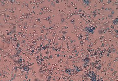 Malassezia_in_LPCB_Tease_Mount_Microscopy