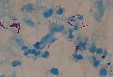 Acid_fast_bacilli_of_Mycobacterium_tuberculosis