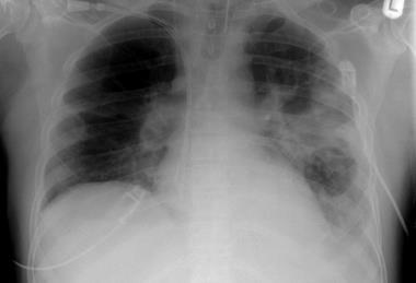 XR_chest_-_pneumonia_with_abscess_and_caverns_-_d0