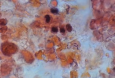 Pneumococcus_in_Gram-Stained_BAL_Sample