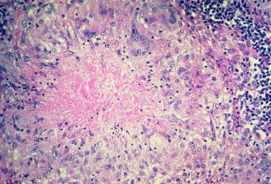 Pulmonary_tuberculosis_-_Necrotizing_granuloma_(6545186957)