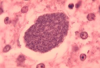 Histopathology_of_malaria_exoerythrocytic_forms_in_liver_07G0024_lores