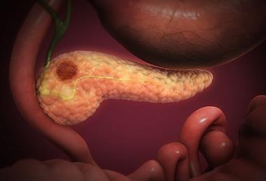 Pancreatic_Cancer