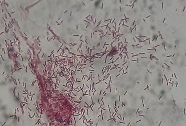 Gram_negative_rods_(GNRs)_of_Pseudomonas_aeruginosa_in_Gram_staining_of_BAL