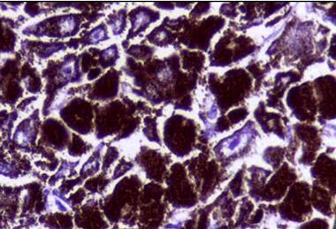 Histopathology_of_Malignant_melanoma