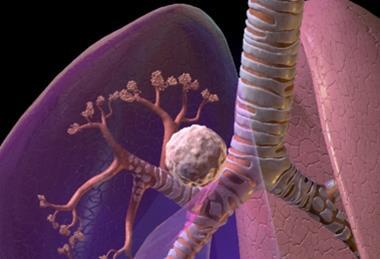Blausen_0619_LungCancer