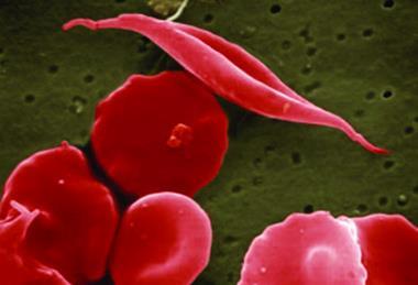 Sickle_cells_illustration