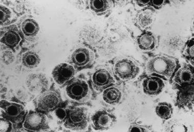 Herpes_simplex_virus_TEM_B82-0474_lores