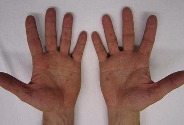 Characteristic_rash_of_hand,_foot,_and_mouth_disease,_on_human_hands