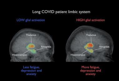 Low-Res_Covid-patient_brain-image
