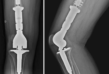 Knee_arthroplasty_due_to_a_chondrosarcoma_2