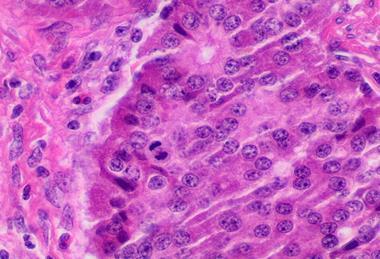 Mitosis_in_a_neuroendocrine_tumor_(original)