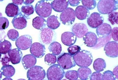 Epstein-barr_virus_(ebv)