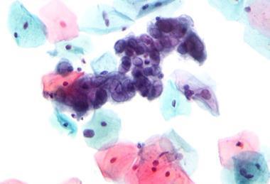 Herpes_simplex_virus_pap_test_2