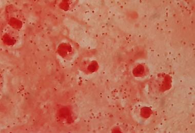 Gram_negative_coccobacilli_of_Acinetobacter_in_bronchoalveolar_lavage_(BAL)_Gram_staining