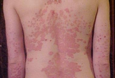 Psoriasis_on_back1