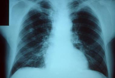 Pneumonia_x_ray