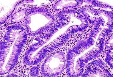 960px-Colon_adenoma_(1)