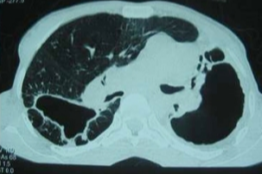 Bilateral_fibrosis_and_pleural_thickening_in_an_infection_with_non-tuberculosis_mycobacteria_(view_from_above)
