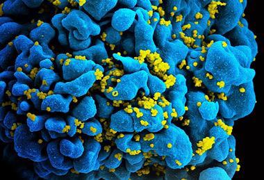 960px-HIV-infected_T_cell_(6813384933) (1)