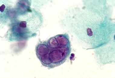 Herpes_on_Pap_test,_original