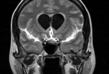 FLAIR_MRI_of_meningitis