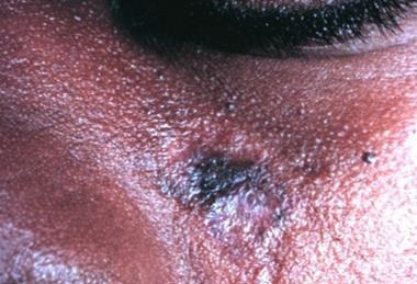 Discoid_lupus_erythematosus