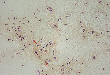 Clostridium_difficile_