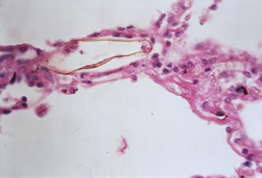 Schistosomiasis_(13382771945)