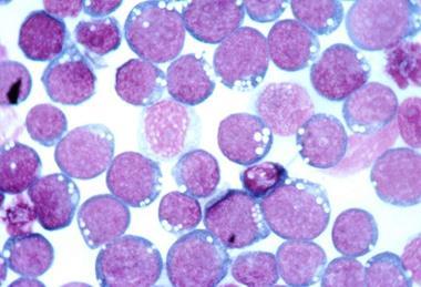 Epistein-Barr_Virus_(EBV)