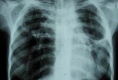 lungs