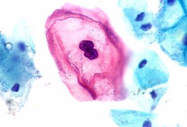HPV-Infected_Squamous_Cell_(Koilocyte)_of_the_Cervix_(44001403165)