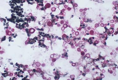 Cryptococcosis_-_Mucicarmine_stain_(5280759612)