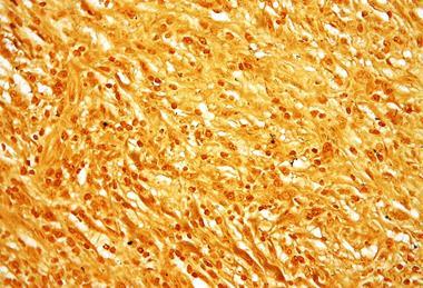Treponema_pallidum_-_very_high_mag