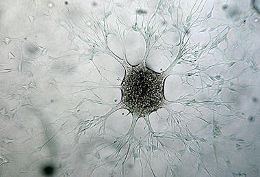 Immagine_di_cellula_di_Glioblastoma_multiforme_della_mia_linea_cellulare_patentata_presso_ECACC_ANGMCSS