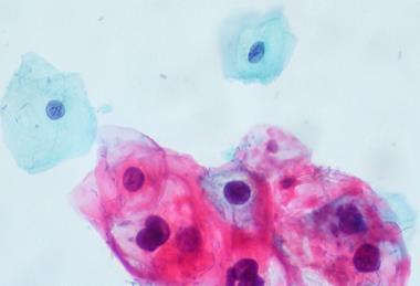 CIN_1-HPV_on_ThinPrep