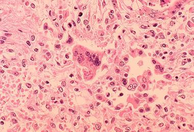 Measles_pneumonia_-_Histopathology (1)