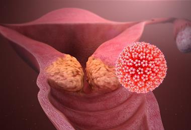 HPV_causing_cervical_cancer