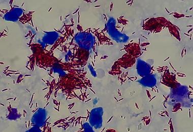 Mycobacterium leprae bacteria
