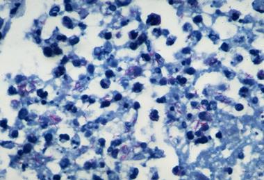 Pulmonary_tuberculosis_-_Numerous_acid_fast_bacilli_in_area_of_acute_inflammation_(6545178883)