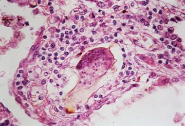 Schistosomiasis_(13383125494)