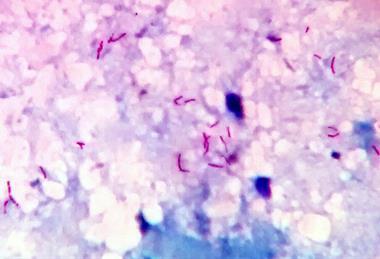 Acid_fast_bacilli_in_sputum_smear