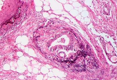Tumor_invasion_into_vein_in_a_case_of_colorectal_cancer,_Elastica_stain_2
