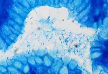 Helicobacter_pylori,_Gastric_Biopsy,_Giemsa_Stain_(5517582111)