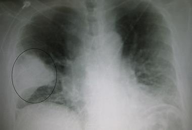 Pneumonia in lung