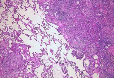 Pulmonary_tuberculosis_(6545189731)