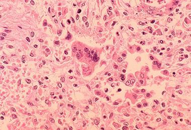 Measles_pneumonia_-_Histopathology