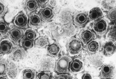 Herpes_simplex_virions,_TEM