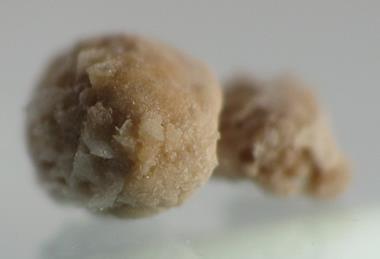 800px-Kidney_stone_4mm_05